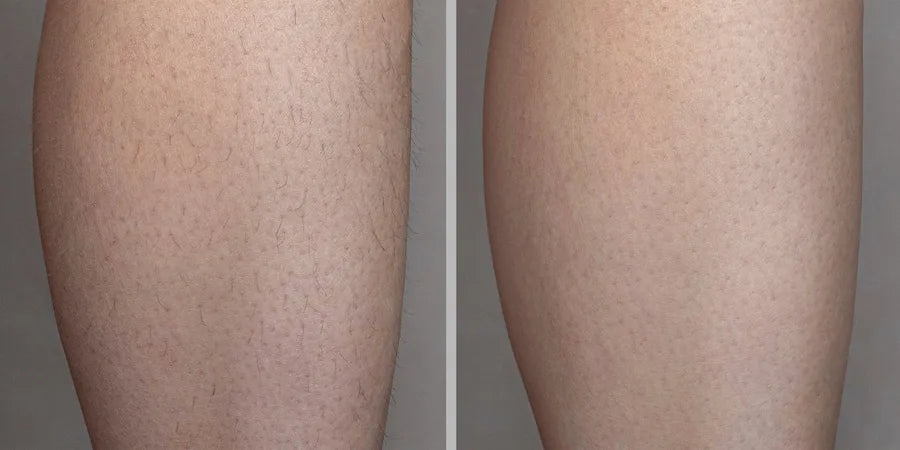 Piernas antes y después